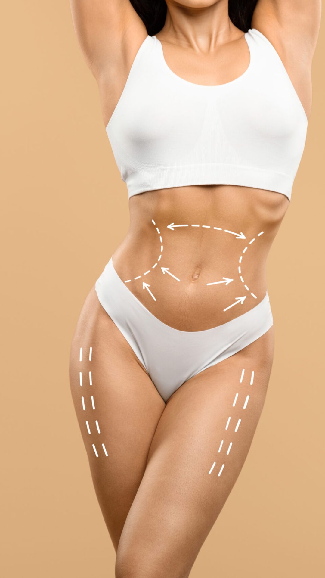 Body Contouring Concept. Cropped Shot Of Slim Female Torso With Drawn Lifting Up Lines On It, Unrecognizable Woman In White Underwear With Perfect Figure Standing On Beige Studio Background, Collage